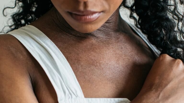 Eczema