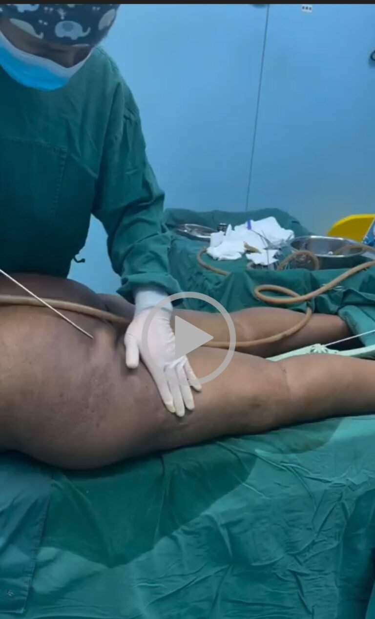 Video Of Lady Undergoing BBL Surgery Sparks Mixed Reactions [VIDEO]